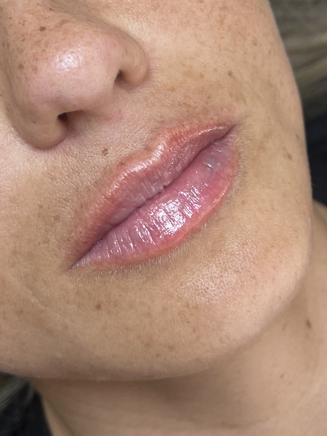 Nuze depois do ajuste de contorno e volume labial